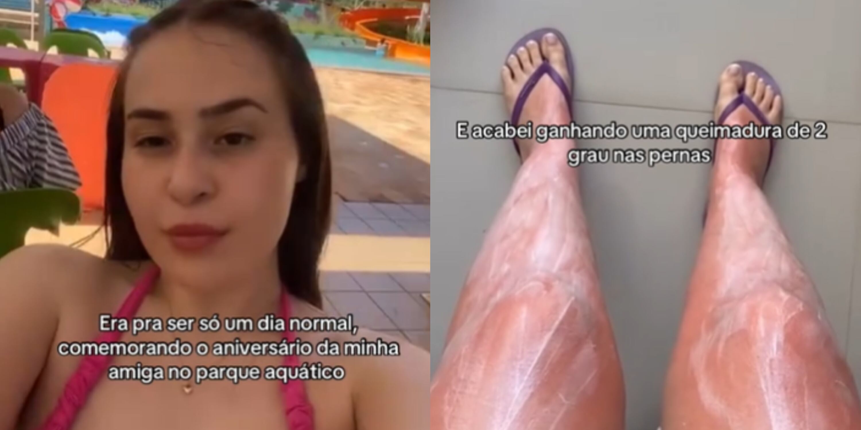 Jovem viraliza ao esquecer de passar protetor solar nas pernas e sofrer queimadura de 2º grau
